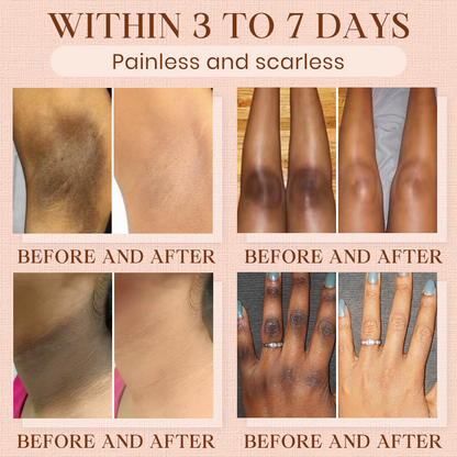 Luhaka® Purifying Exfoliating Gel for Acanthosis Nigricans, Exfoliation, Dark Spots, Skin Tags, and Eczema